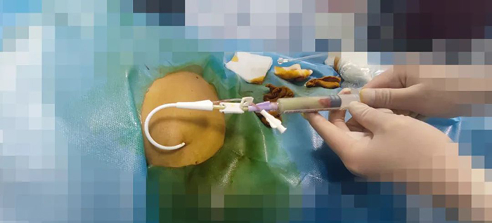 西藏阜康醫(yī)院成功實施一例超聲引導下肝膿腫置管引流術(shù)